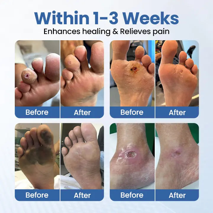 DiabeticFoot🌿¡Crema reparadora para piel en Diabéticos! Promo 45%Off