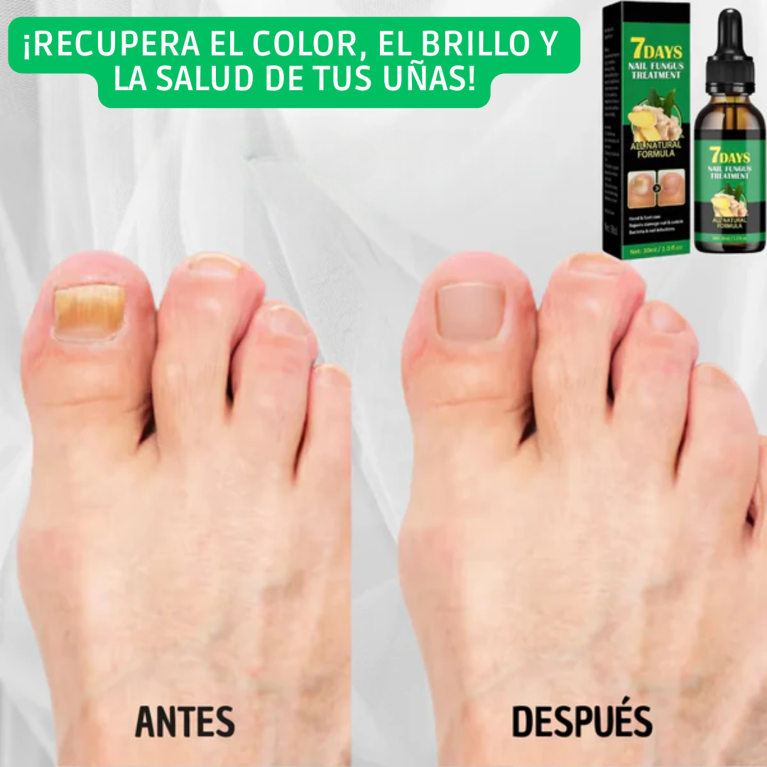 🌿Aceite Natural Antihongos y Fortalecedor de Uñas🌿¡Black Fridayl Pague 1 y lleve el 2 Gratis!