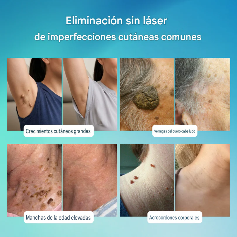 Roll-on DermaClear™ ¡Despídete de verrugas y lunares, sin dolor y sin cicatriz🌿¡PROMO 45% OFF SOLO POR HOY!