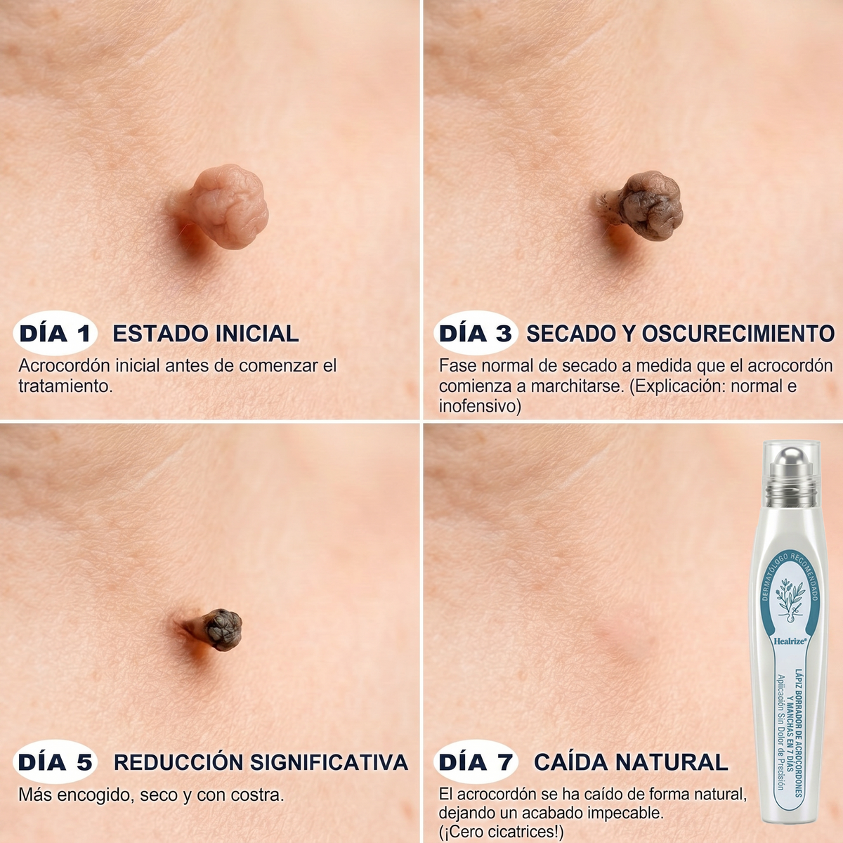 Roll-on DermaClear™ ¡Despídete de verrugas y lunares, sin dolor y sin cicatriz🌿¡PROMO 45% OFF SOLO POR HOY!