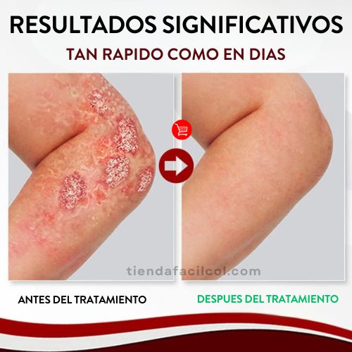 🌿Spray ¡Alivio inmediato de la picazón y descamación! Pague 1 y Lleve el 2 Gratis!