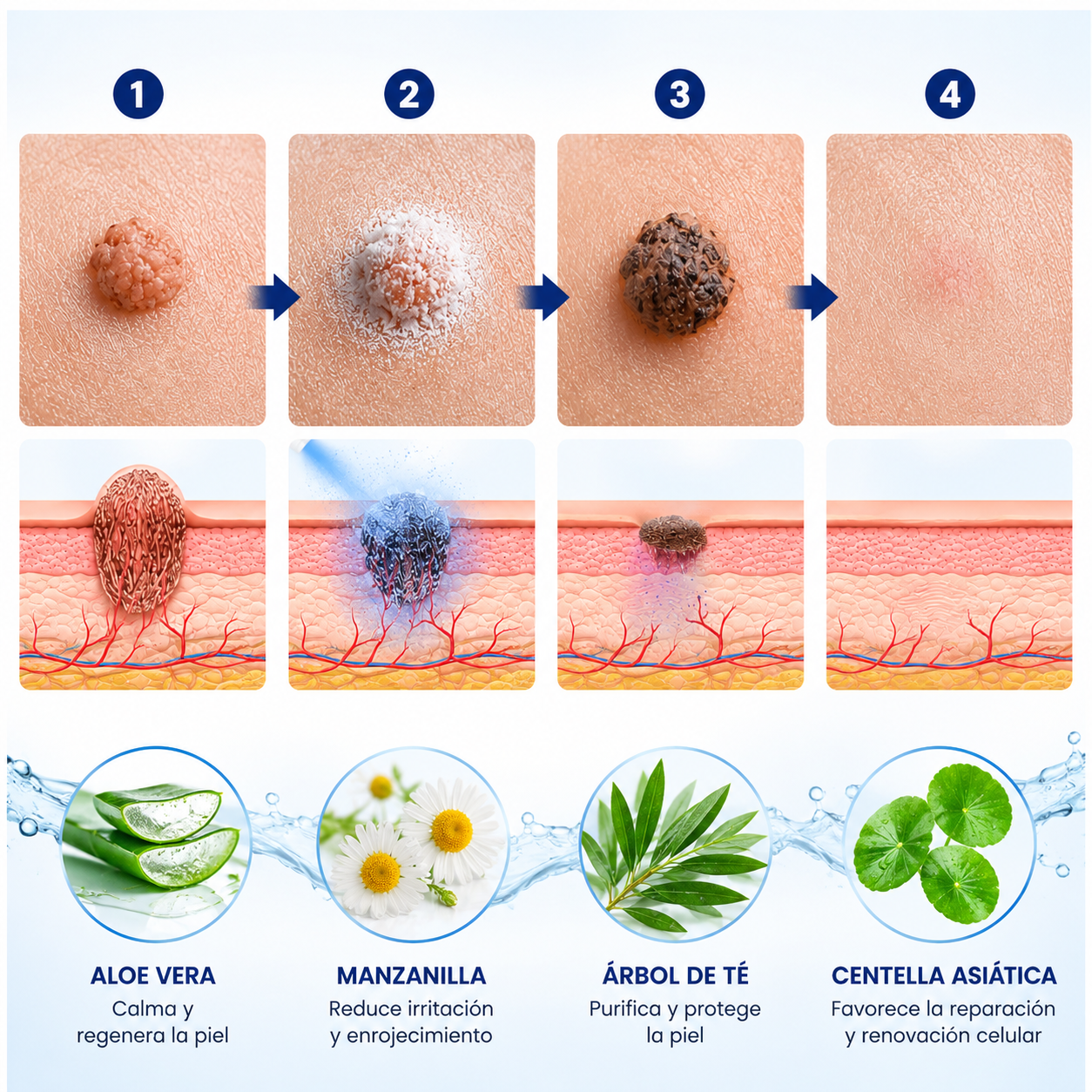 CryoClear🌿¡Despídete de verrugas y lunares, sin dolor y sin cicatriz¡ PROMO 45% OFF SOLO POR HOY!