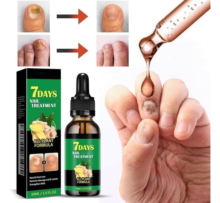 🌿Aceite Natural Antihongos y Fortalecedor de Uñas🌿¡Black Fridayl Pague 1 y lleve el 2 Gratis!