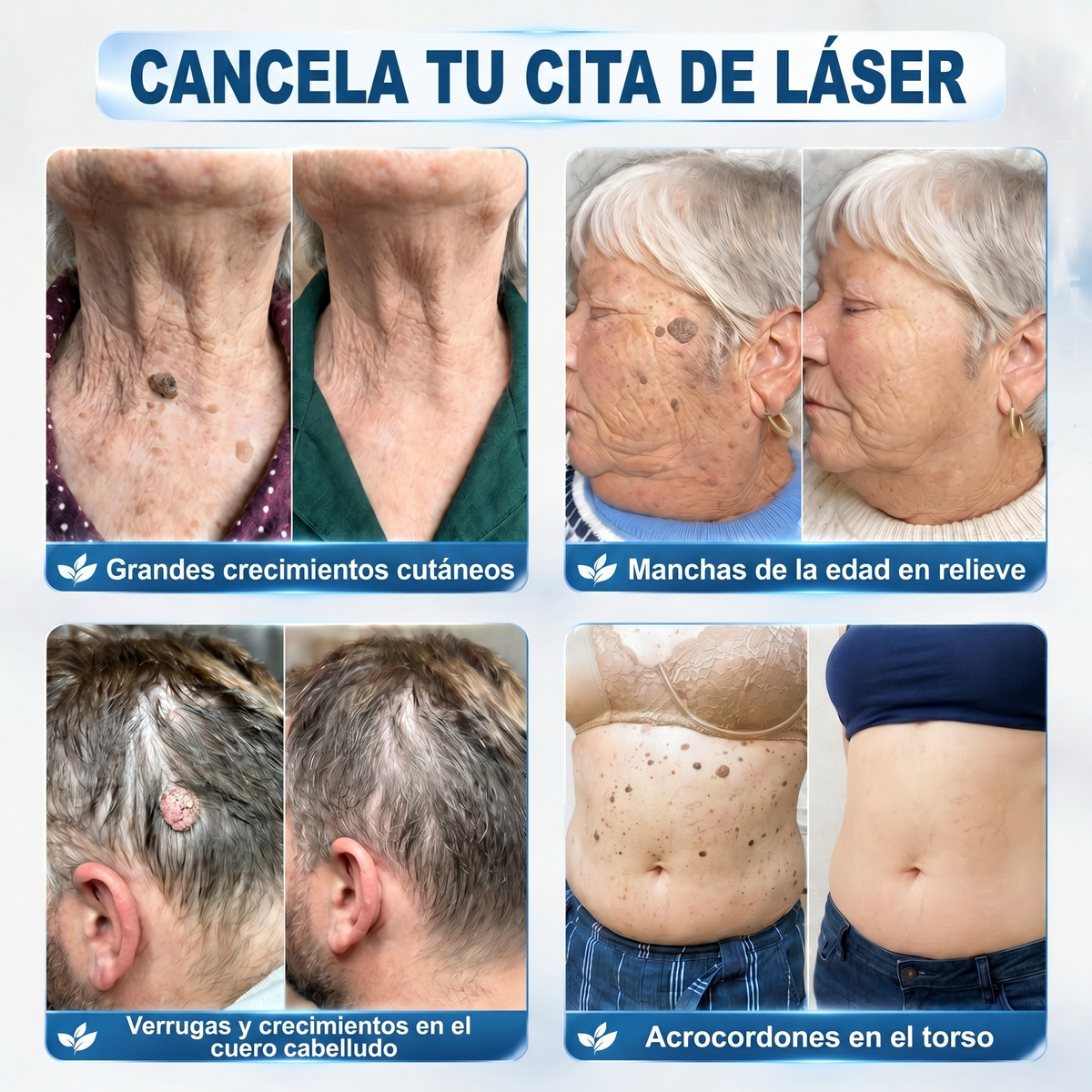 Roll-on DermaClear™ ¡Despídete de verrugas y lunares, sin dolor y sin cicatriz🌿¡PROMO 45% OFF SOLO POR HOY!