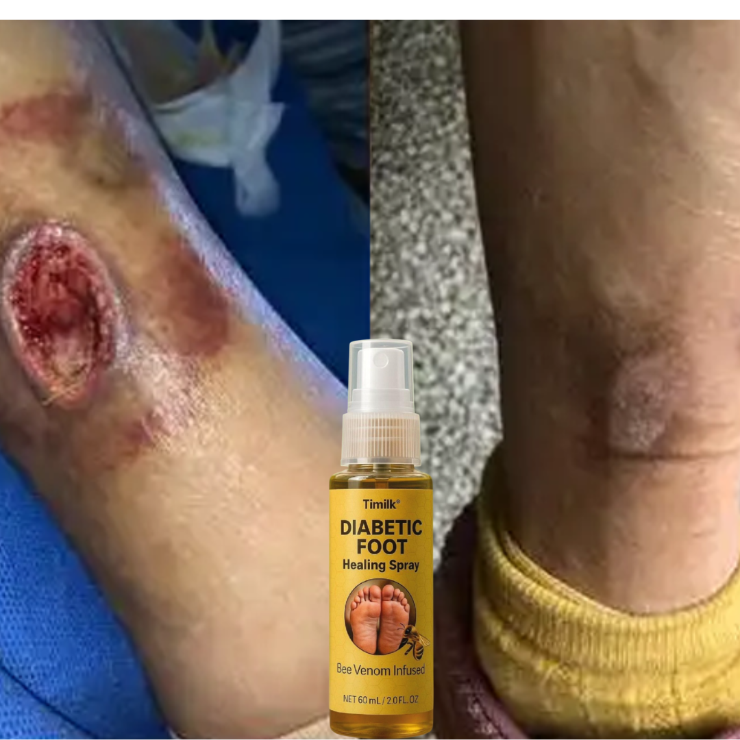 Spray Diabetic🌿¡Alivio natural y cicatrización de pie diabético! Pague 1 y lleve el 2 Gratis!