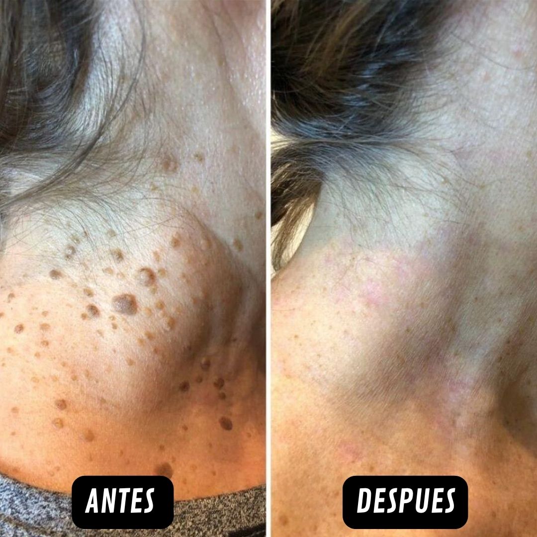 CryoClear🌿¡Despídete de verrugas y lunares, sin dolor y sin cicatriz¡ PROMO 45% OFF SOLO POR HOY!