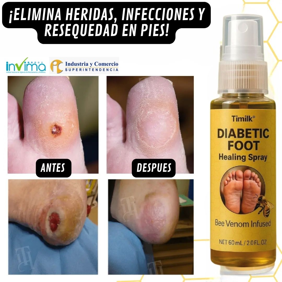 Timilk Diabetic🌿¡Spray curativo para pies diabéticos, Alivio natural y cicatrización de piel diabética!