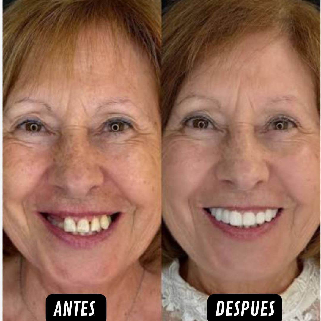 SmileOne™ Carillas dentales ¡Sonríe, come y habla con seguridad, renueva tu sonrisa!