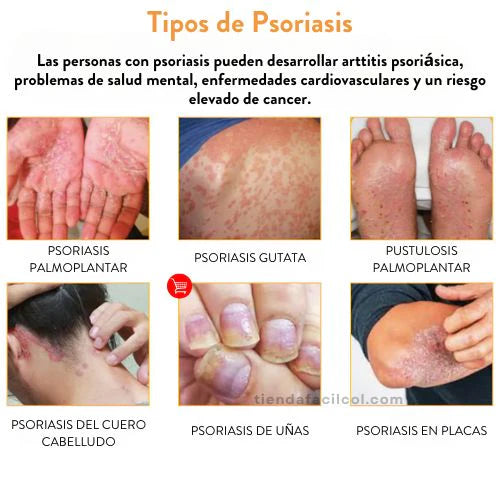 🌿Spray ¡Alivio inmediato de la picazón y descamación! Pague 1 y Lleve el 2 Gratis!