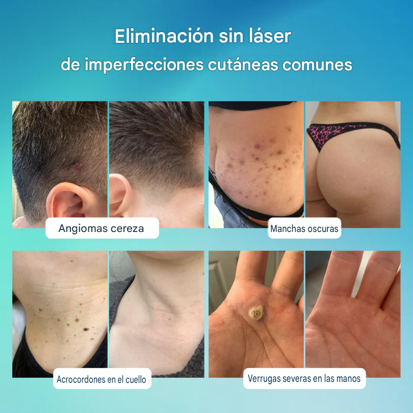 Roll-on DermaClear™ ¡Despídete de verrugas y lunares, sin dolor y sin cicatriz🌿¡PROMO 45% OFF SOLO POR HOY!